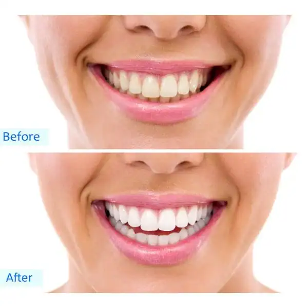 Woman's before and after results for Blue Light Teeth Whitening Havant