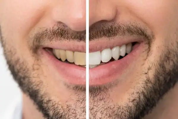 Before and after results for Blue Light Teeth Whitening Havant