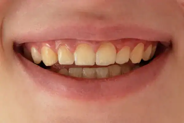 foods that are known to stain teeth Havant